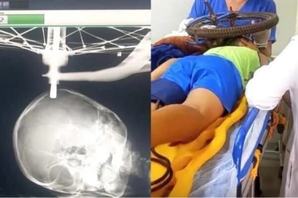Criança cai de bicicleta e fica com a roda presa no crânio em Conceição das Alagoas-MG
