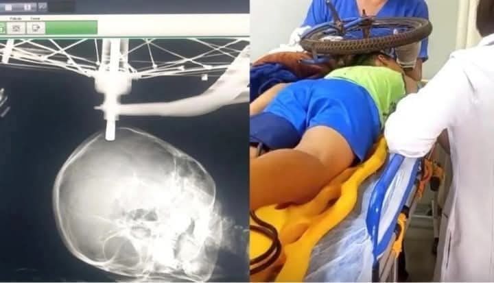 Criança cai de bicicleta e fica com a roda presa no crânio em Conceição das Alagoas-MG