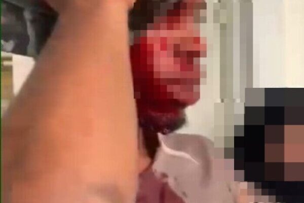 Homem atingido com golpes de madeira na cabeça mostra ferimento em Nova Friburgo