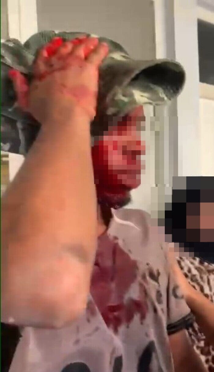 Homem atingido com golpes de madeira na cabeça mostra ferimento em Nova Friburgo