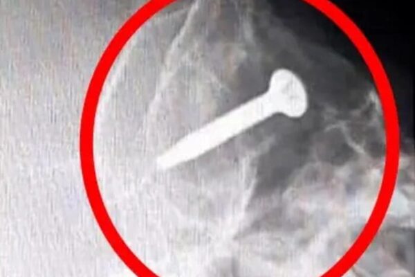 Exame mostra parafuso enfiado em olho de trabalhador após acidente de trabalho