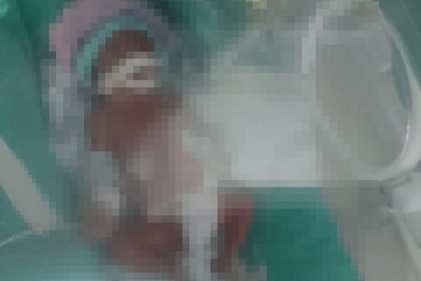 Uma mulher em uma maca de hospital, coberta por um lençol branco e com uma roupa verde escura, durante um procedimento médico.