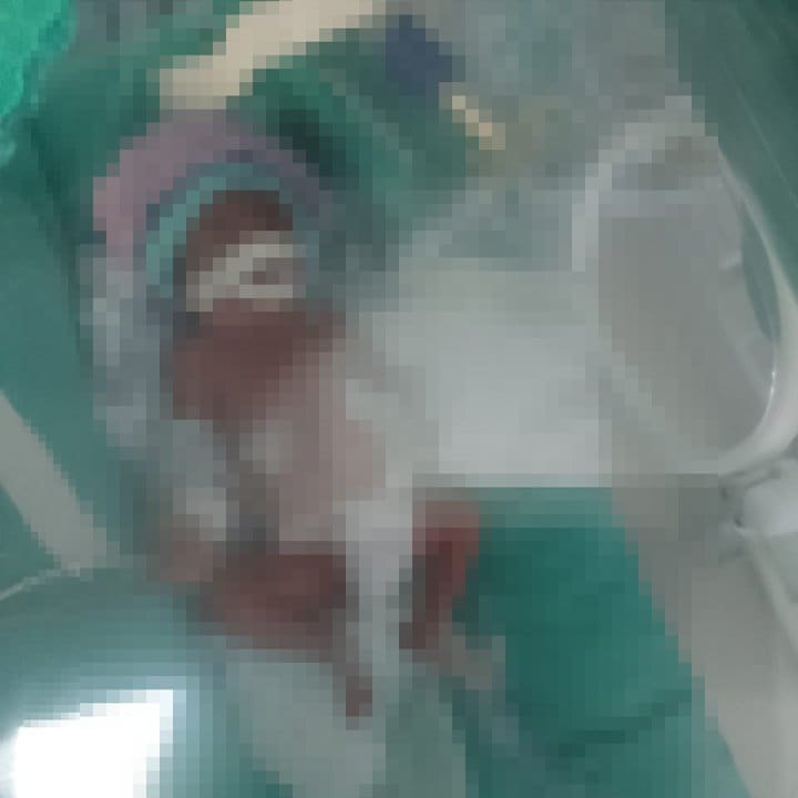 Uma mulher em uma maca de hospital, coberta por um lençol branco e com uma roupa verde escura, durante um procedimento médico.